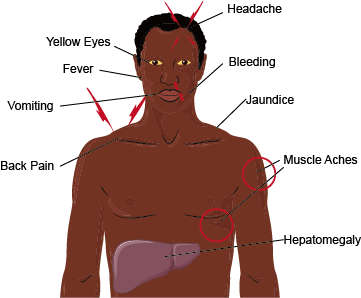 Major symptom of yellow fever